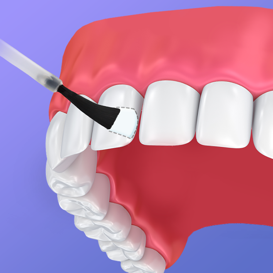 Fluoride Treatment